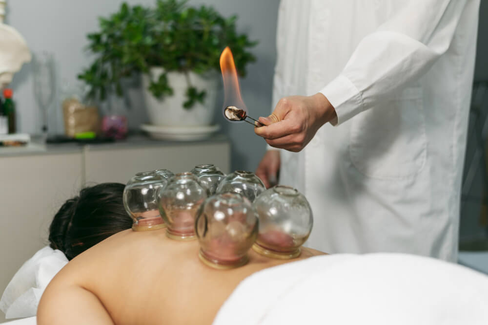 Fire Cupping Therapy